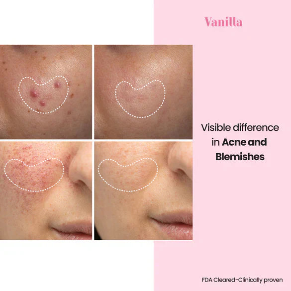 EMS Light Face  therapy device